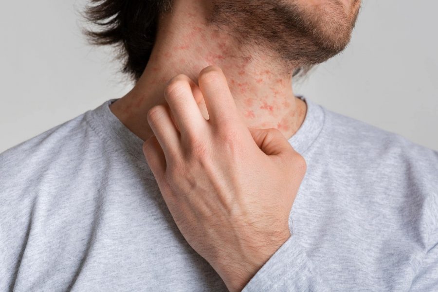 5 Съвета За Предотвратяване На Екзема и Други Кожни Заболявания