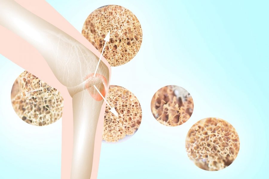 5 Начина За Предотвратяване На Остеопорозата