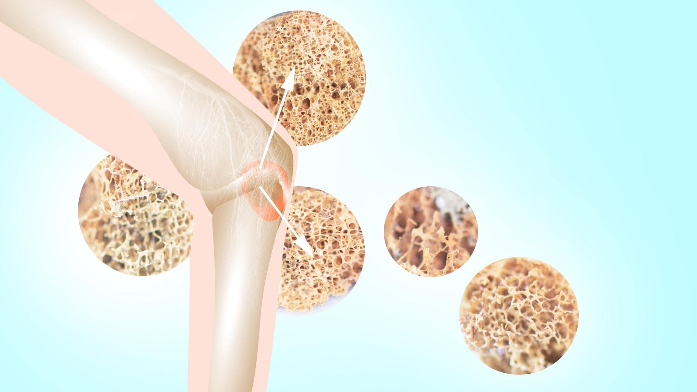 5 Начина За Предотвратяване На Остеопорозата