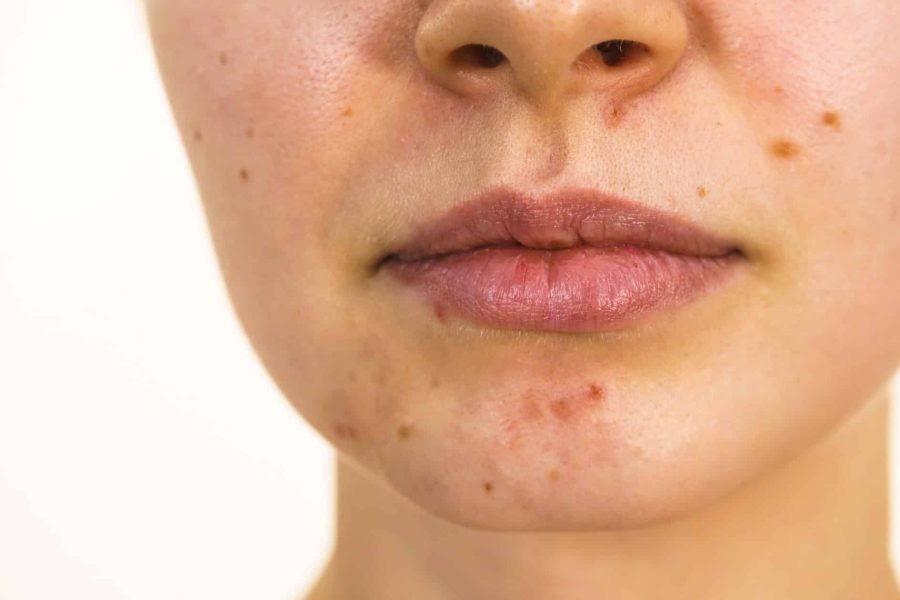 5 Лесни Начина За Предотвратяване и Намаляване На Белезите От Акне