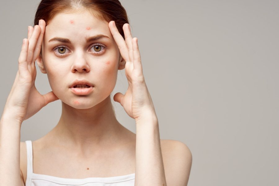 6 Съвета За Борба с Акнето